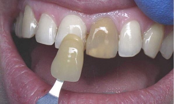 7 вопросов про отбеливание зубов