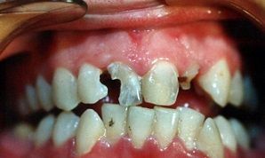 Негативные последствия скученности зубов