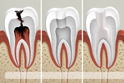 Удаление нерва в зубе – зачем, когда и как?