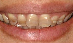 Как появляется желтый налет на зубах?