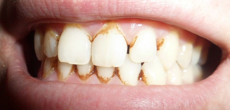 Зубные Камни - Как Избавиться, Снять У Стоматолога