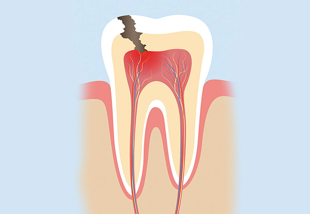 Что делать, если болит зуб под пломбой